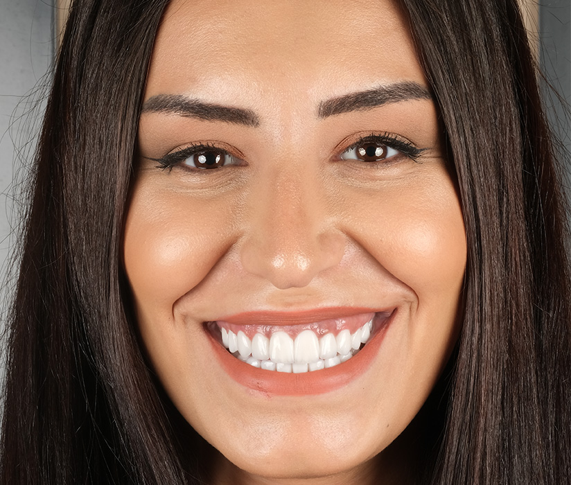 EMAX Veneers